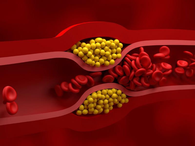 La lipoproteína de baja densidad (LDL), comúnmente conocida como colesterol malo, tiene la capacidad de unirse a grasas y otras sustancias, acumulándose en las paredes internas de las arterias. Esta acumulación puede provocar el estrechamiento y la obstrucción de las arterias, lo que a su vez reduce el flujo sanguíneo. (Nemes Laszlo/Science Photo Library a través de Getty Images)